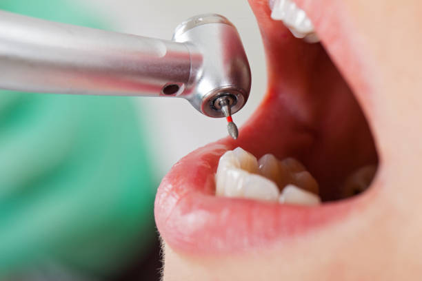 Best Emergency Dentist for Lost Fillings or Crowns in Dyer, IN